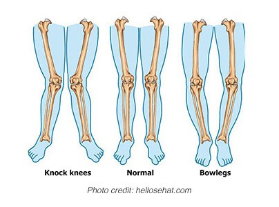 Limb Deformity/ Length Discrepancy - Columbia Asia Hospital I Private ...