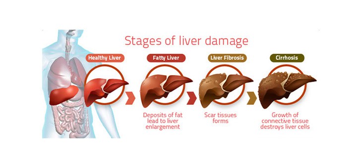 Fatty Liver - Columbia Asia Hospital I Private Hospital in Malaysia