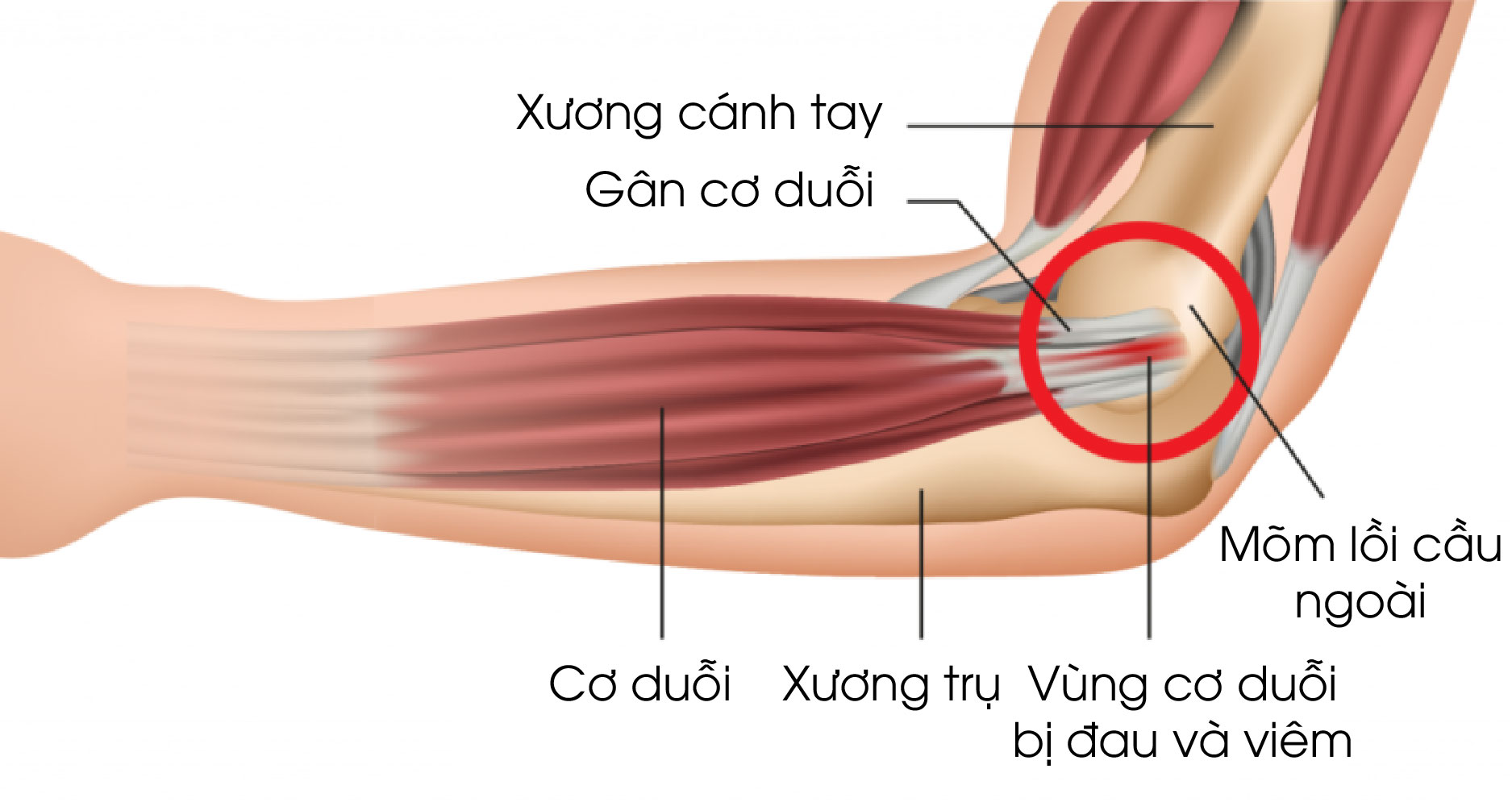 Hội chứng đau khuỷu tay Tennis - Elbow\'s tennis | Columbia Asia ...